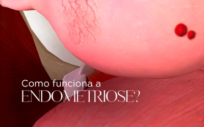 Como funciona a endometriose?